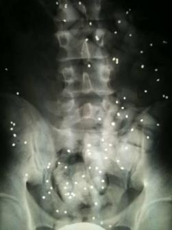 spezifische Ursache für Rückenschmerzen