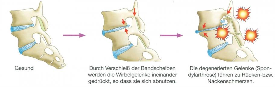 Osteochondrose der LWS